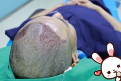 -大麦微针植发丨全国连锁