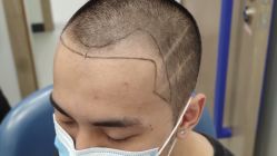 -大麦微针植发全国连锁