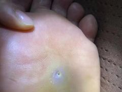 -世龙世家灰指甲鸡眼脚气甲沟炎跖疣护理(通州店)