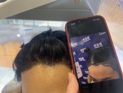 -碧莲盛·不剃发植发