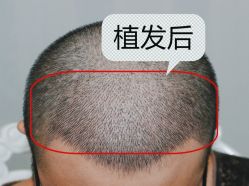 -大麦微针植发全国连锁