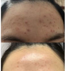 -苗方清颜痘肌研究所