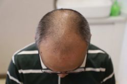 -大麦微针植发丨全国连锁
