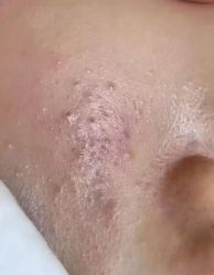 -苗方清颜专业祛痘·皮肤管理