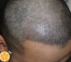 -大麦微针植发丨全国连锁