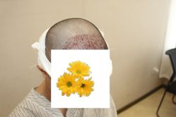 -大麦微针植发丨全国连锁