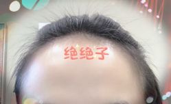 -大麦微针植发全国连锁