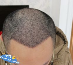 -大麦微针植发丨全国连锁