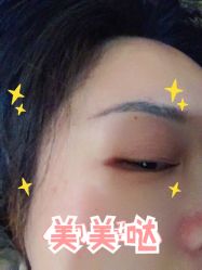 体验后-More摩尔医美の注射线雕光电中心