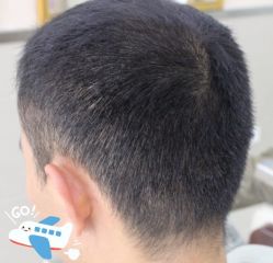 -大麦微针植发全国连锁
