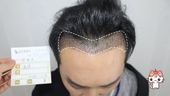 -大麦微针植发丨全国连锁