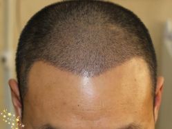 -大麦微针植发丨全国连锁