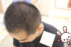 -大麦微针植发丨全国连锁