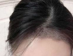 -大麦微针植发丨全国连锁