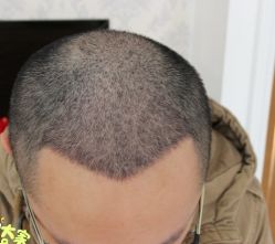 -大麦微针植发丨全国连锁