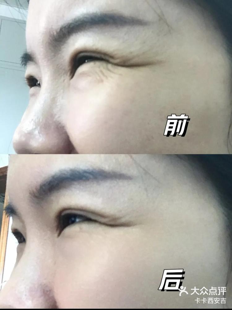 鱼尾纹打了之后感觉年轻好多