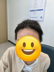 体验后-大麦微针植发全国连锁