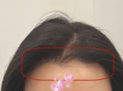 -大麦微针植发全国连锁