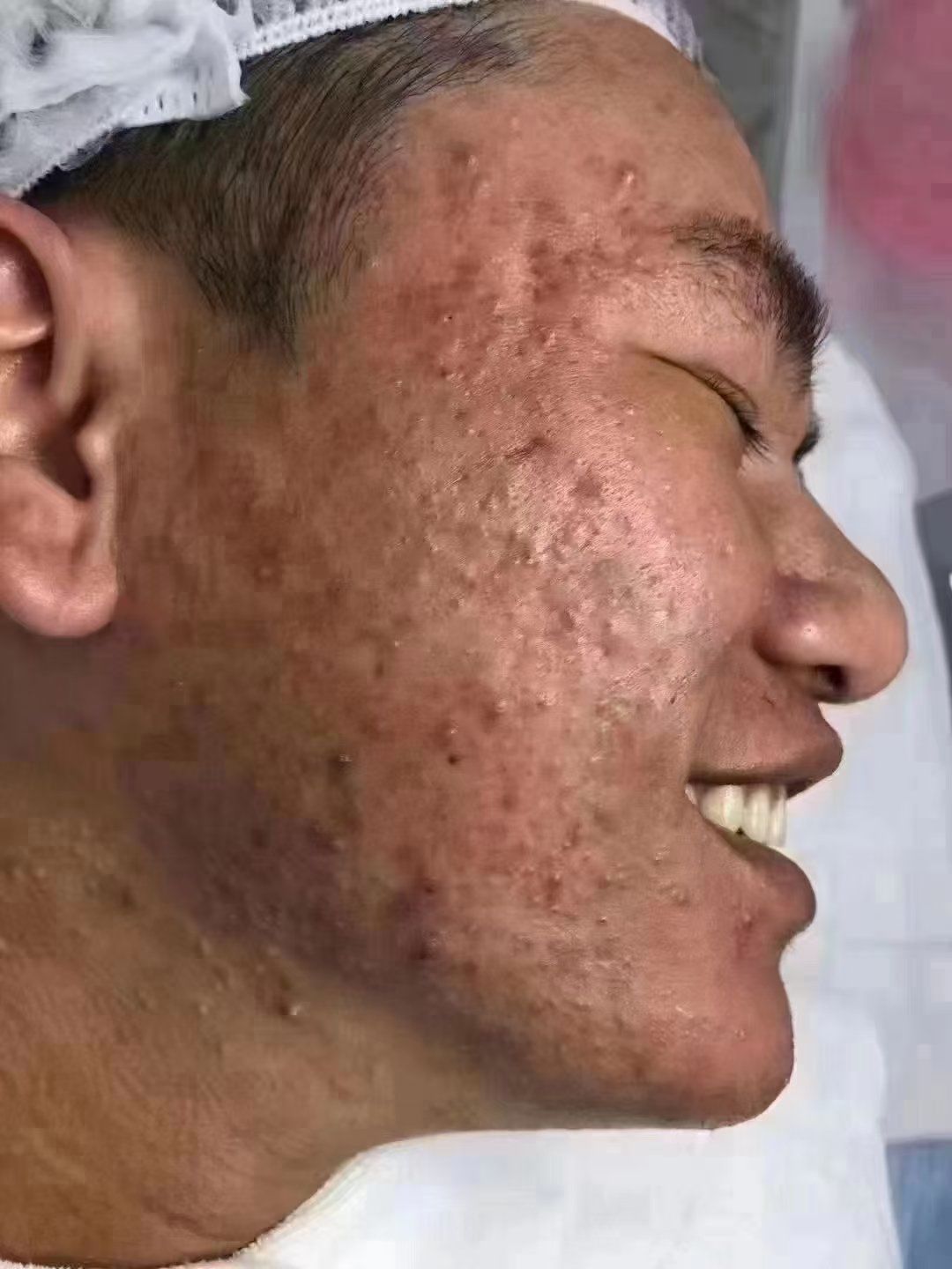 痘痘消失记,你值得拥有