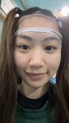 -大麦微针植发丨全国连锁