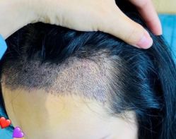 -大麦微针植发丨全国连锁