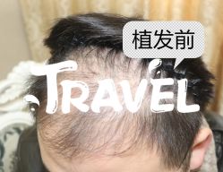 -大麦微针植发全国连锁