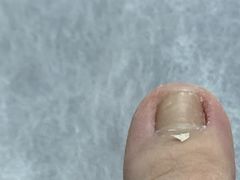 -世龙世家灰指甲鸡眼脚气甲沟炎跖疣护理(通州店)