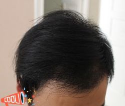 -大麦微针植发丨全国连锁