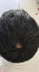 -大麦微针植发丨全国连锁