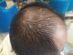 -碧莲盛·不剃发植发