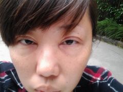 开完眼皮眼角第一天，还有本人大眼袋，肿的-上海华安整形外科门诊部