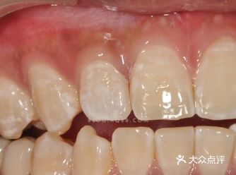 1.什么是氟斑牙？ 氟斑牙又叫斑釉