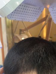 -碧莲盛·不剃发植发