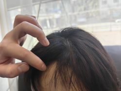 -碧莲盛·不剃发植发