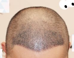 -大麦微针植发全国连锁