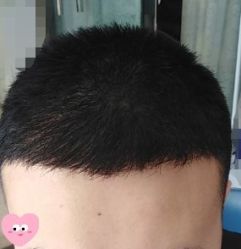 -大麦微针植发丨全国连锁