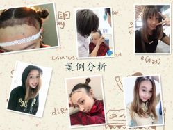 -大麦微针植发全国连锁