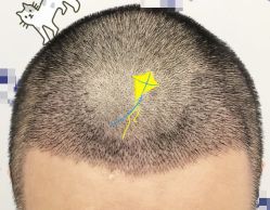 -大麦微针植发全国连锁