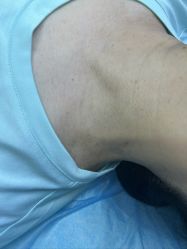 体验前-美丽人生祛斑扁平疣汗管瘤中心