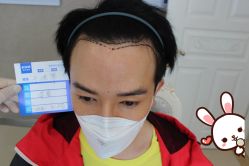 -大麦微针植发丨全国连锁