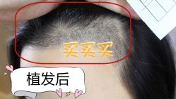 -大麦微针植发全国连锁