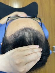 -大麦微针植发全国连锁