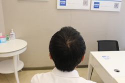 -大麦微针植发丨全国连锁