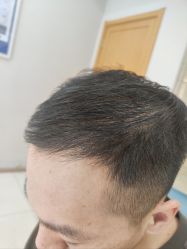 -大麦微针植发丨全国连锁