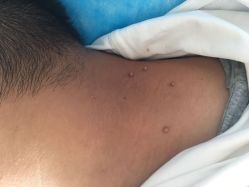 -爱莎扁平疣·汗管瘤·斑痣中心