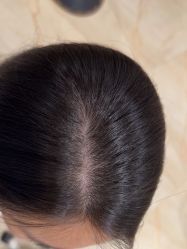 -碧莲盛·不剃发植发