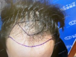 -碧莲盛·不剃发植发