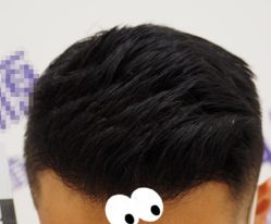 -大麦微针植发全国连锁