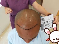 点击看大图 -大麦微针植发丨全国连锁