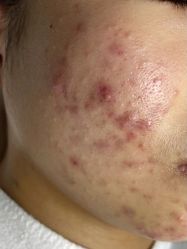 -美肤盾祛痘·问题肌头疗管理中心